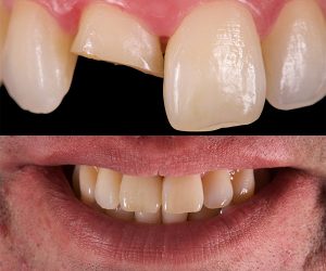 Fractura-Coronal-Tras-Accidente