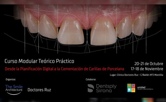 Curso Estética Dental Desde la Planificación Digital a la Cementación de Carillas de Porcelana – Montilla