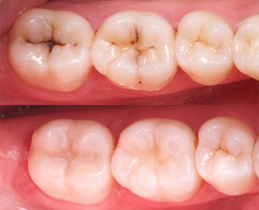 Lesiones Cariosas en Surcos Profundos