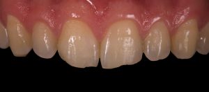 blanqueamiento-dental-en-castellon-antes