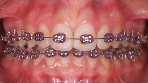 brackets-metalicos-castellon