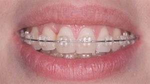 brackets-zafiro-castellon