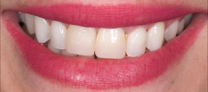 cirugia-oral-estetica-castellon