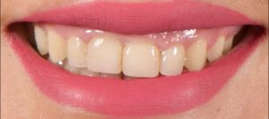 cirugia-oral-estetica-castellon-antes