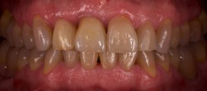 implante-dental-castellon