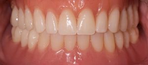 implante-sobre-dentadura-castellon