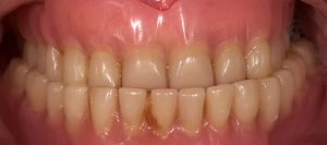 implante-sobre-dentadura-castellon-antes