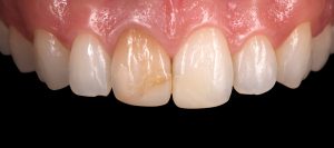 microcarilla-porcelana-dentistas-castellon-antes