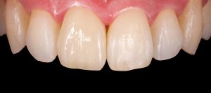 prostodoncia-dental-castellon-despues