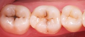 restauracion-dental-castellon-antes