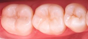 restauracion-dental-castellon-despues