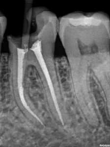 ENDO CASO 2 DESPUES