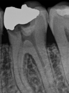 Dientes después