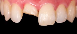prostodoncia-clinica-dental-castellon-2