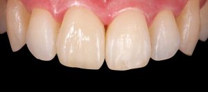 prostodoncia-clinica-dental-castellon