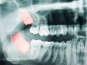 Cirugía oral clínica dental Castellón
