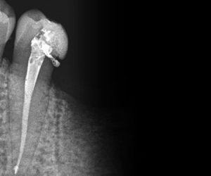 endodoncia-clinica-castellon