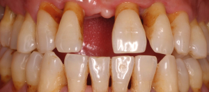 implantologia-clinica-dental-castellon-2