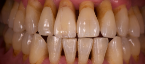 implantologia-clinica-dental-castellon