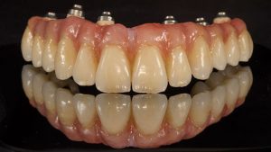 Periodoncia dental Castellón