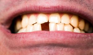 Rotura dental de urgencias