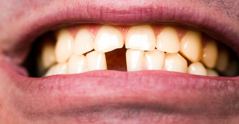 Rotura dental de urgencias Cómo actuar ante un traumatismo dental