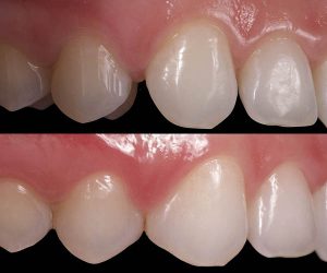 Cierre diastema con composite estético