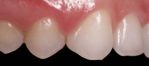 cierre de diastema con composite estético clínica dental