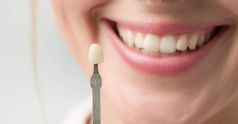 blanqueamiento-dental-clinica-castellon Pon solución a tus dientes amarillos