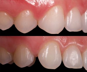 Cierre de diastema con composites estéticos