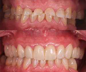 coronas de zirconio cad cam en paciente bruxista