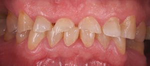 coronas de zirconio cad cam en paciente bruxista antes