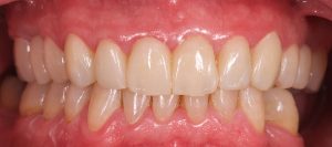 coronas de zirconio cad cam en paciente bruxista después