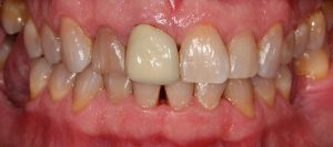 Implante dental unitario en central y molares antes