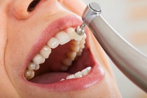 Limpieza dental Castellón