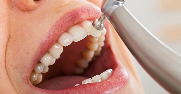 Limpieza dental Castellón Elimina el sarro de tus dientes