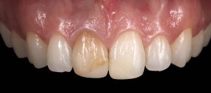 Microcarilla dental de cerámica Castellón