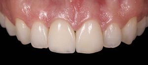 Microcarilla dental de cerámica Castellón