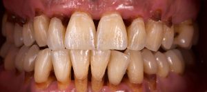 periodoncia después