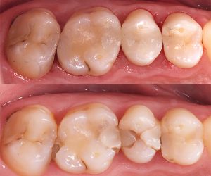 Reconstrucciones de composite posterior
