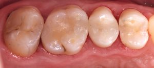 Reconstrucciones de composite posterior después