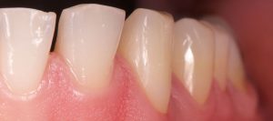 Restauración de composite en dientes con abfracción después