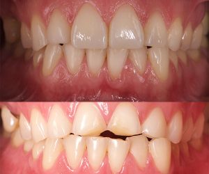 restauración de composite estético en paciente con erosión dental