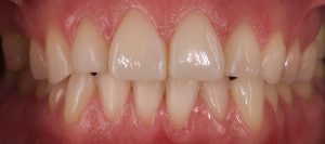 restauración de composite estético en paciente con erosión dental despues