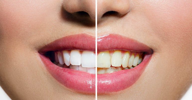 Blanqueamiento dental Castellón Blanqueamiento dental Castellón
