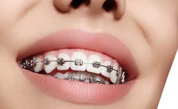 Cuida tu boca incluso con ortodoncia
