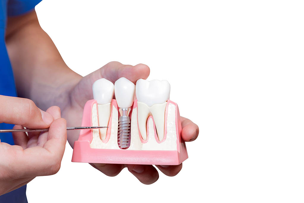 Implante dental Castellón