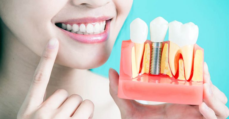 Implante dental periimplantitis Evita la periimplantitis tras los implantes dentales