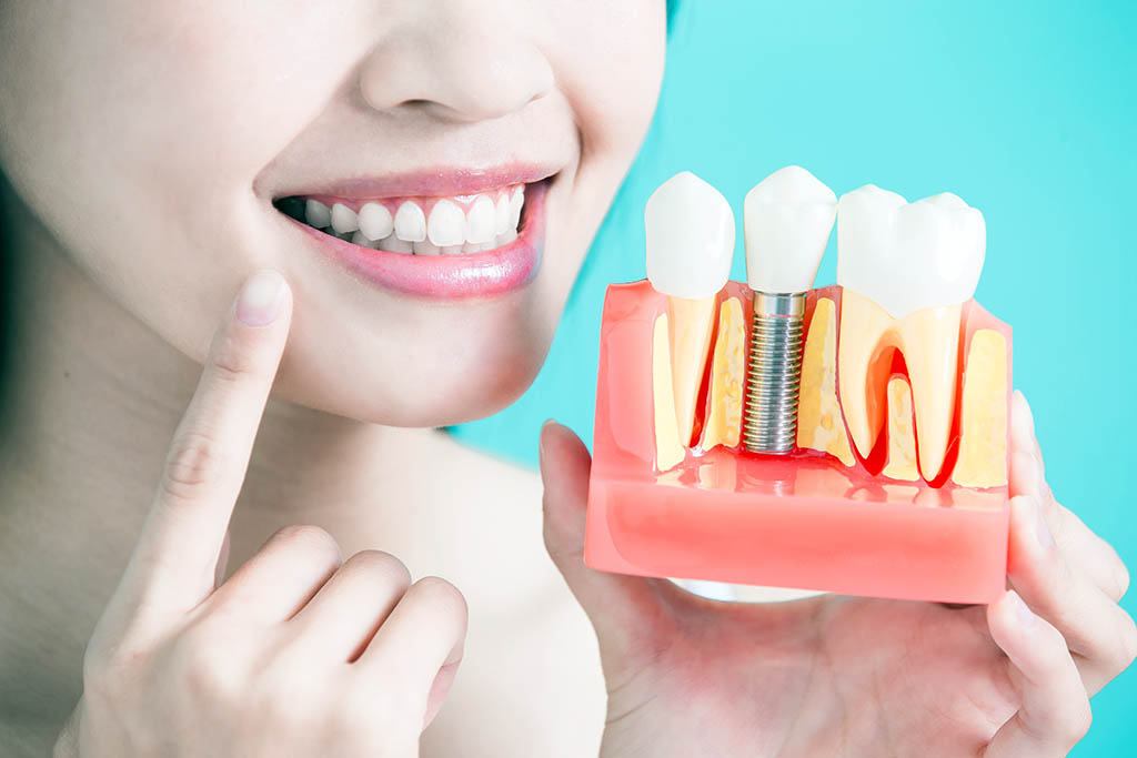 Implante dental periimplantitis