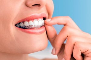 Ortodoncia Invisalign